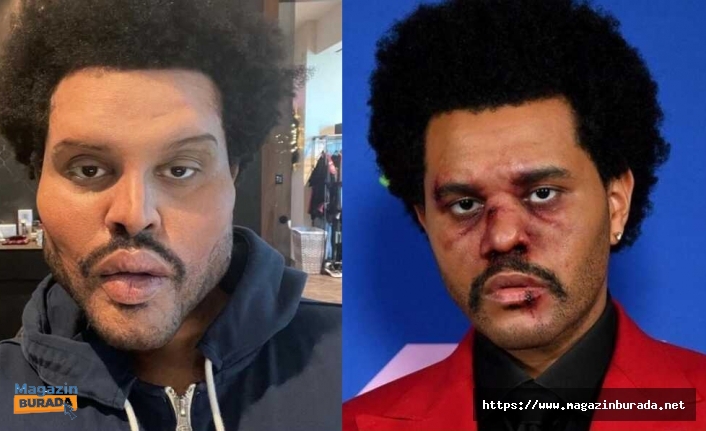 Son Karesi ile Hayranlarını Şok Etti! The Weeknd’in Yüzüne Ne Oldu?